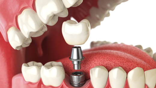 Elevating Oral Precision: The Science of Dental Implant Accuracy