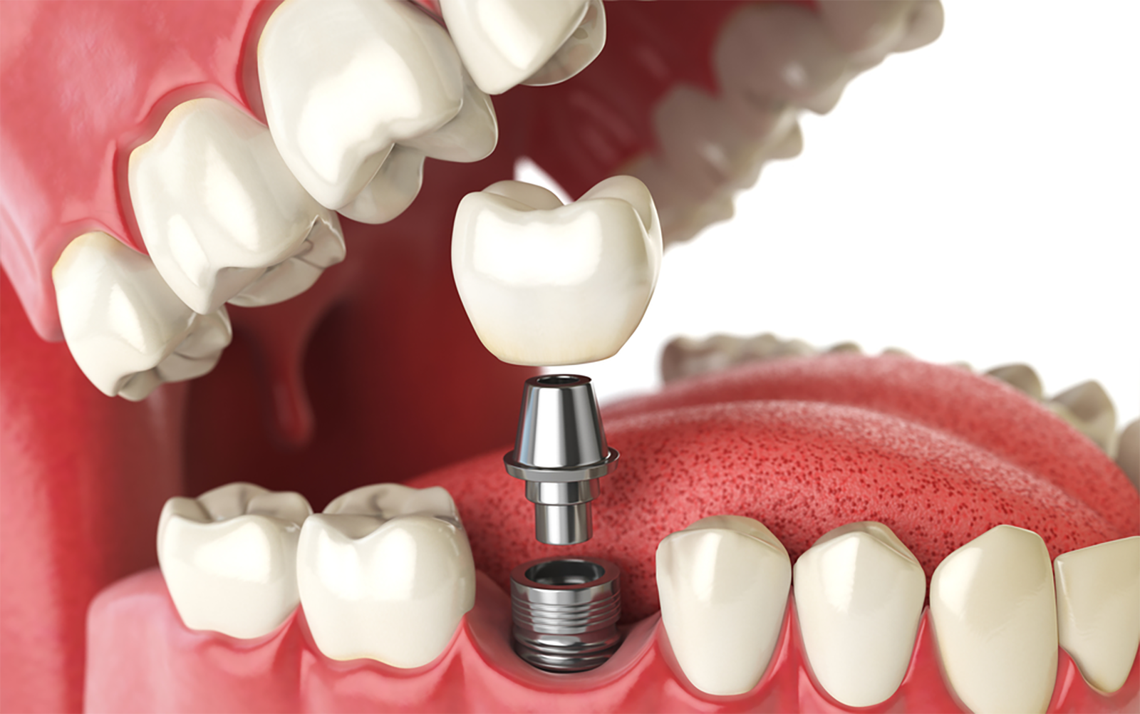 Elevating Oral Precision: The Science of Dental Implant Accuracy