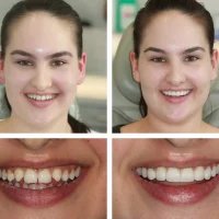 Redefining Smile Texture with Breakthrough Composite Bonding Techniques
