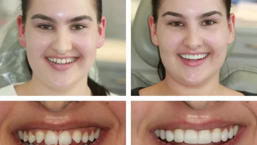Redefining Smile Texture with Breakthrough Composite Bonding Techniques