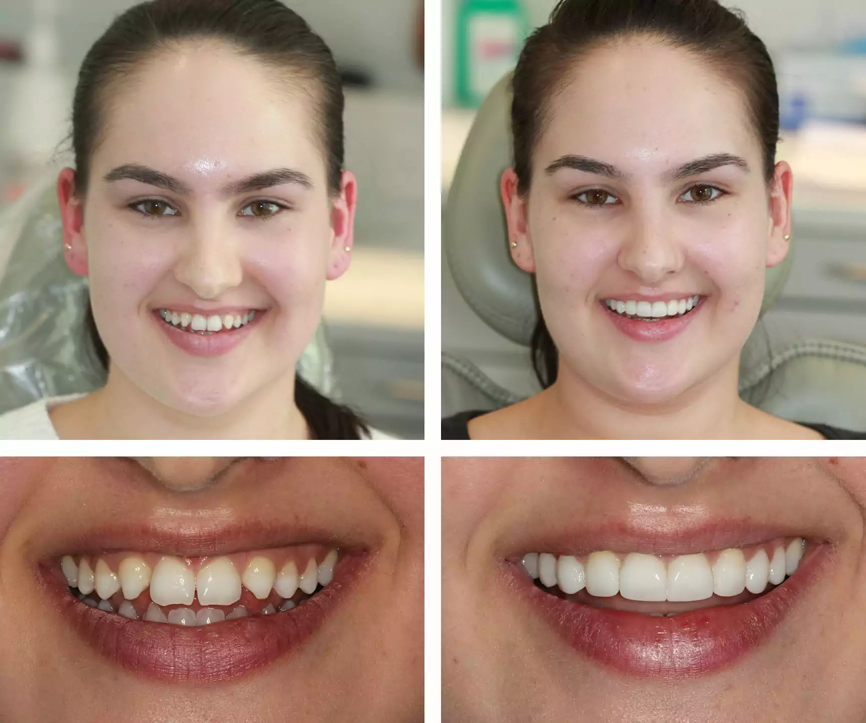 Redefining Smile Texture with Breakthrough Composite Bonding Techniques