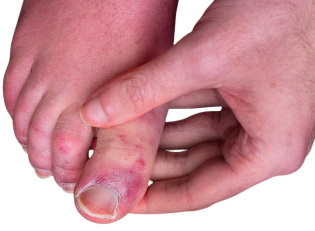 Chilblains
